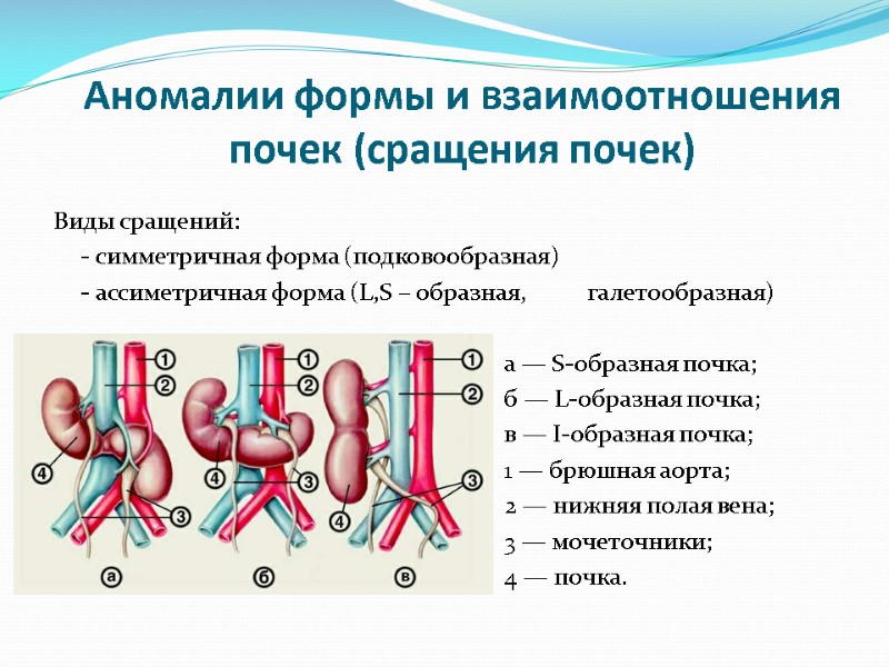 Аномалии формы и взаимоотношения почек (сращения почек) Виды сращений:  - симметричная форма (подковообразная)